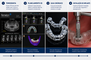 Implante dentário sem corte: como funciona a cirurgia guiada?